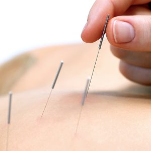 Acupuncture Dublin eUKs.com Special Offers, Deals & Discounts in UK & Ireland