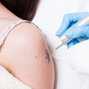 Laser Tattoo Removal at Laser Express Beauty Dublin eUKs.com Special Offers, Deals & Discounts in UK & Ireland