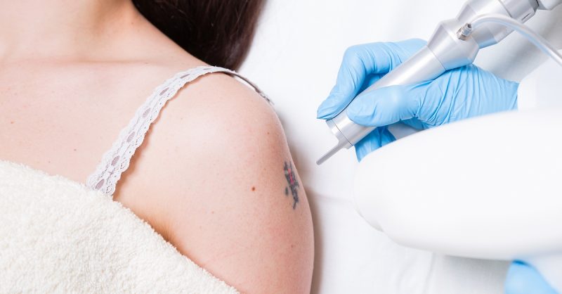 Laser Tattoo Removal at Laser Express Beauty Dublin eUKs.com Special Offers, Deals & Discounts in UK & Ireland
